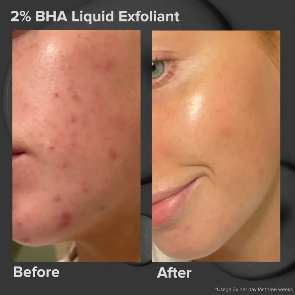 PAULA'S CHOICE Skin Perfecting 2% BHA Liquid Exfoliant